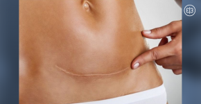 3 вещи которые каждый должен знать о женщинах, которых кесарили